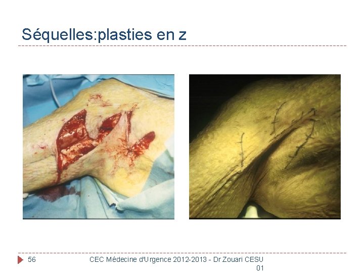 Séquelles: plasties en z 56 CEC Médecine d'Urgence 2012 -2013 - Dr Zouari CESU