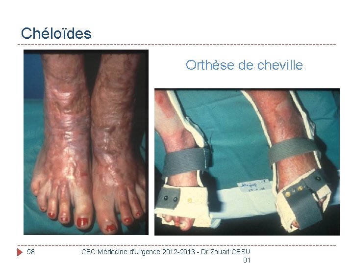 Chéloïdes Orthèse de cheville 58 CEC Médecine d'Urgence 2012 -2013 - Dr Zouari CESU