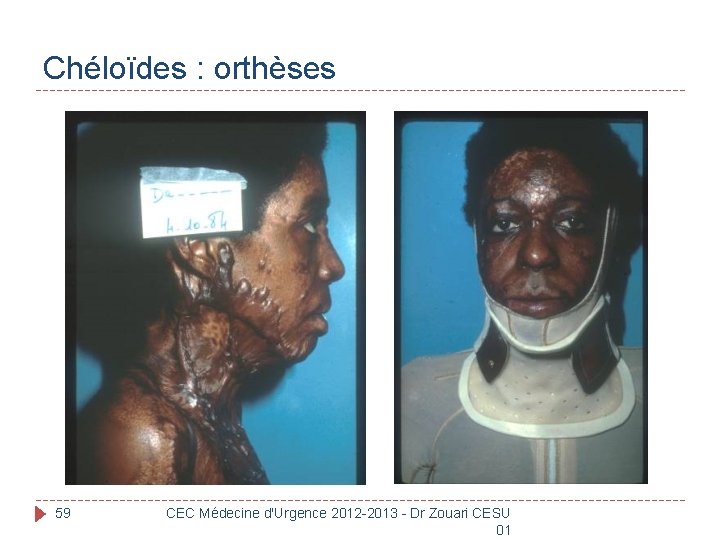 Chéloïdes : orthèses 59 CEC Médecine d'Urgence 2012 -2013 - Dr Zouari CESU 01