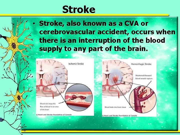 Stroke • Stroke, also known as a CVA or cerebrovascular accident, occurs when there