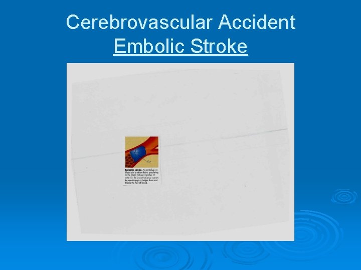 Cerebrovascular Accident Embolic Stroke 