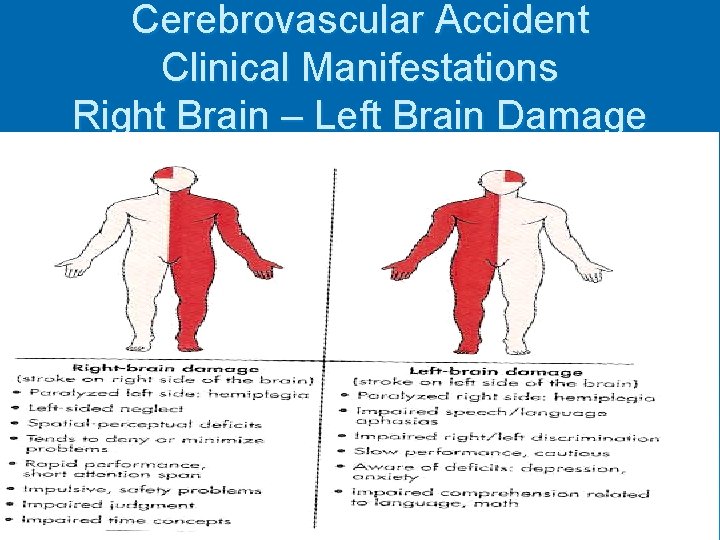 Cerebrovascular Accident Clinical Manifestations Right Brain – Left Brain Damage 