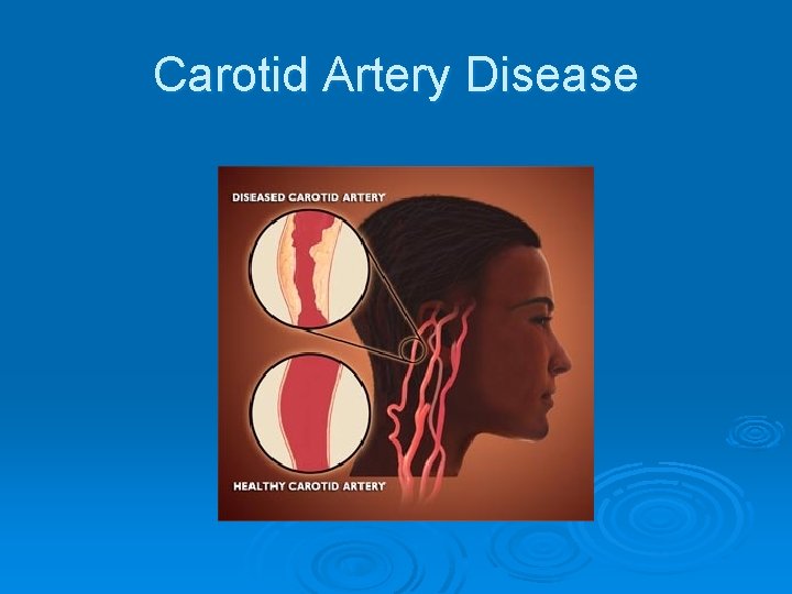 Carotid Artery Disease 
