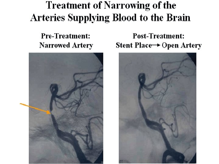 Carotid Artery Stents 