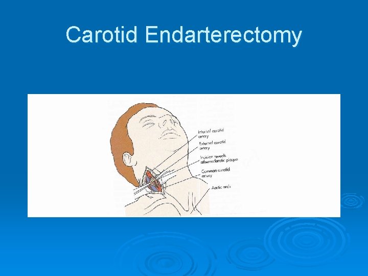 Carotid Endarterectomy 
