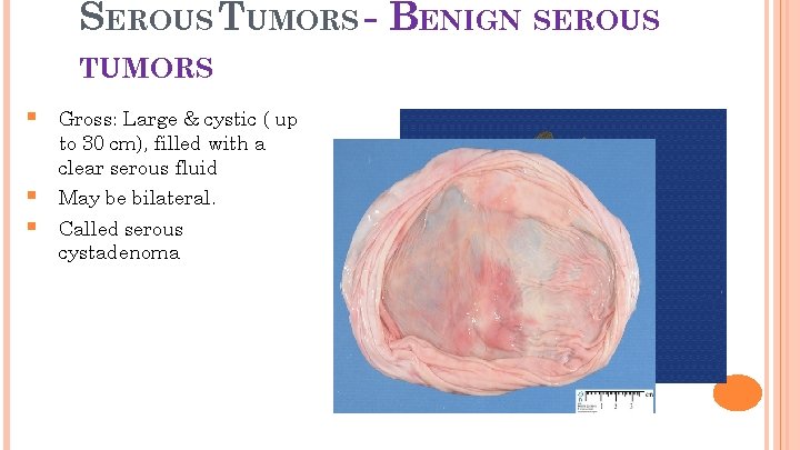 SEROUS TUMORS - BENIGN SEROUS 16 TUMORS § Gross: Large & cystic ( up