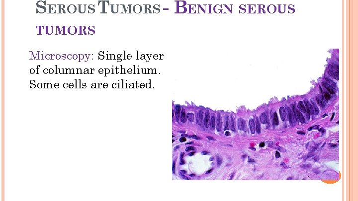 SEROUS TUMORS - BENIGN SEROUS 17 TUMORS Microscopy: Single layer of columnar epithelium. Some
