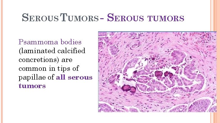 18 SEROUS TUMORS - SEROUS TUMORS Psammoma bodies (laminated calcified concretions) are common in