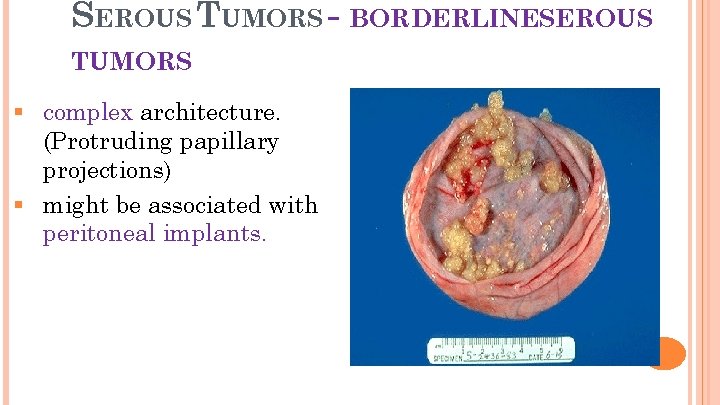 SEROUS TUMORS - BORDERLINESEROUS 19 TUMORS § complex architecture. (Protruding papillary projections) § might