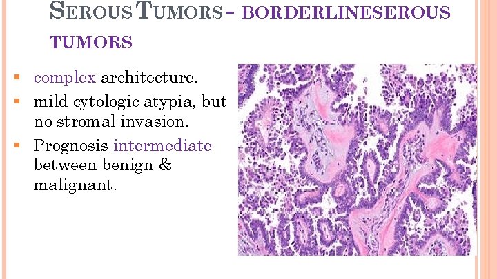 SEROUS TUMORS - BORDERLINESEROUS 20 TUMORS § complex architecture. § mild cytologic atypia, but