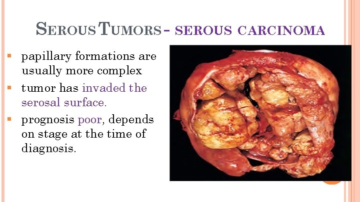 21 SEROUS TUMORS - SEROUS CARCINOMA § papillary formations are usually more complex §