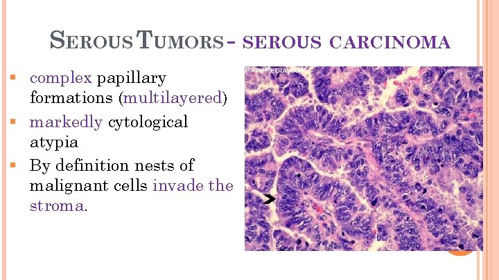 22 SEROUS TUMORS - SEROUS CARCINOMA § complex papillary formations (multilayered) § markedly cytological