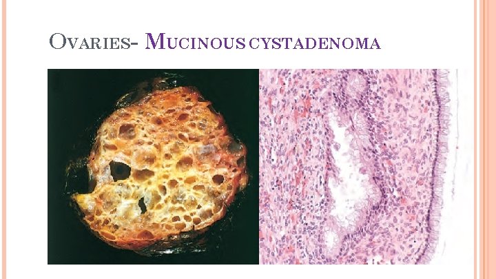 24 OVARIES- MUCINOUS CYSTADENOMA 