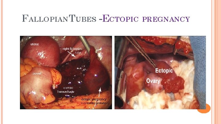 5 FALLOPIAN TUBES -ECTOPIC PREGNANCY 