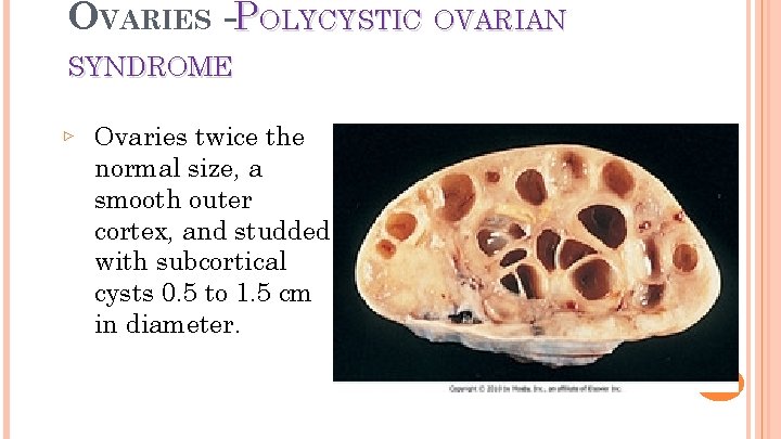 OVARIES -POLYCYSTIC OVARIAN 9 SYNDROME ▹ Ovaries twice the normal size, a smooth outer