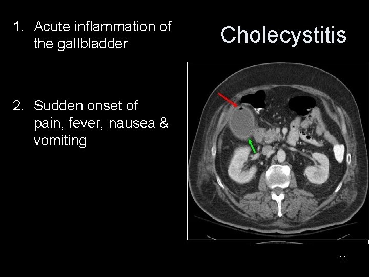 1. Acute inflammation of the gallbladder Cholecystitis 2. Sudden onset of pain, fever, nausea