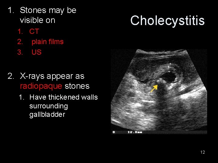 1. Stones may be visible on 1. CT 2. plain films 3. US Cholecystitis