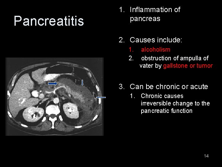 Pancreatitis 1. Inflammation of pancreas 2. Causes include: 1. 2. alcoholism obstruction of ampulla