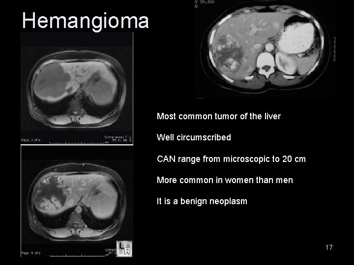 Hemangioma Most common tumor of the liver Well circumscribed CAN range from microscopic to