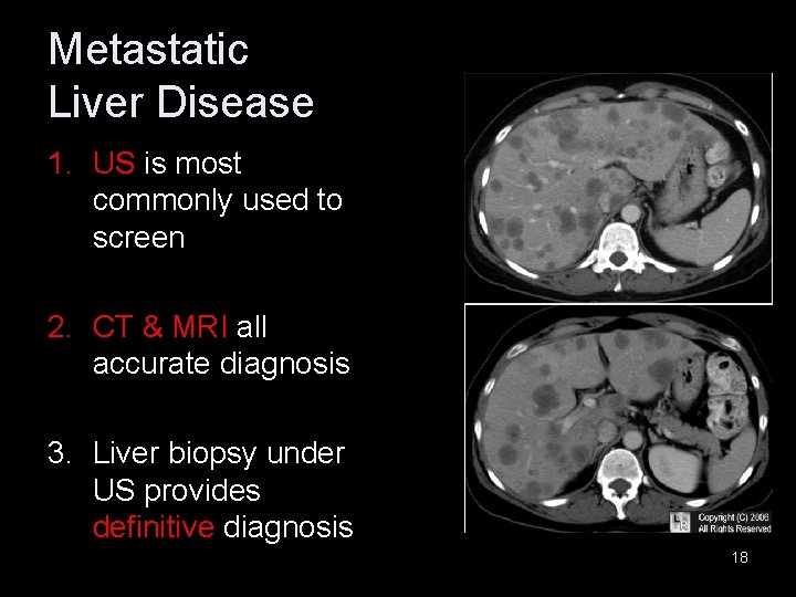 Metastatic Liver Disease 1. US is most commonly used to screen 2. CT &