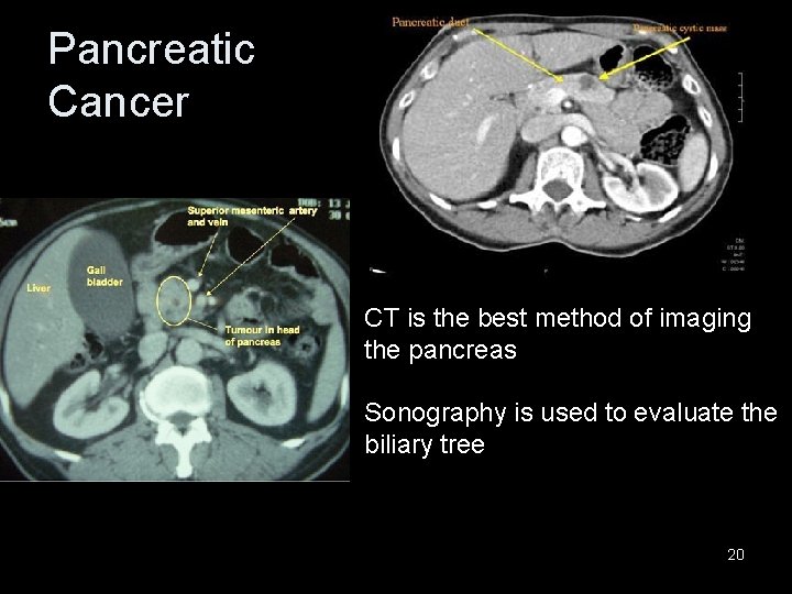 Pancreatic Cancer CT is the best method of imaging the pancreas Sonography is used