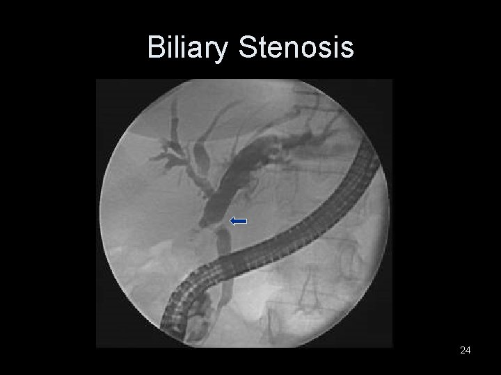 Biliary Stenosis 24 