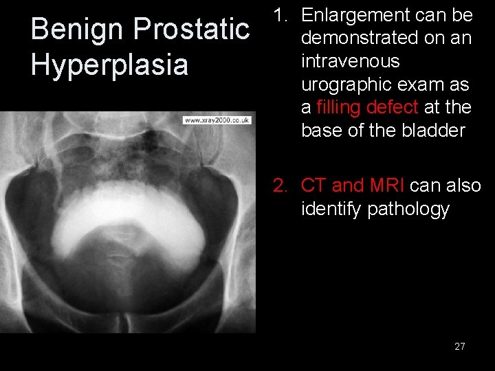 Benign Prostatic Hyperplasia 1. Enlargement can be demonstrated on an intravenous urographic exam as