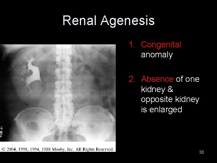 Renal Agenesis 1. Congenital anomaly 2. Absence of one kidney & opposite kidney is