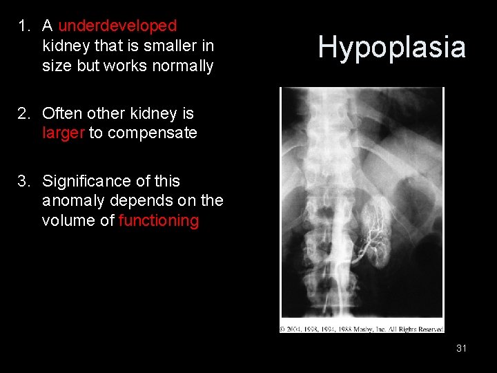 1. A underdeveloped kidney that is smaller in size but works normally Hypoplasia 2.