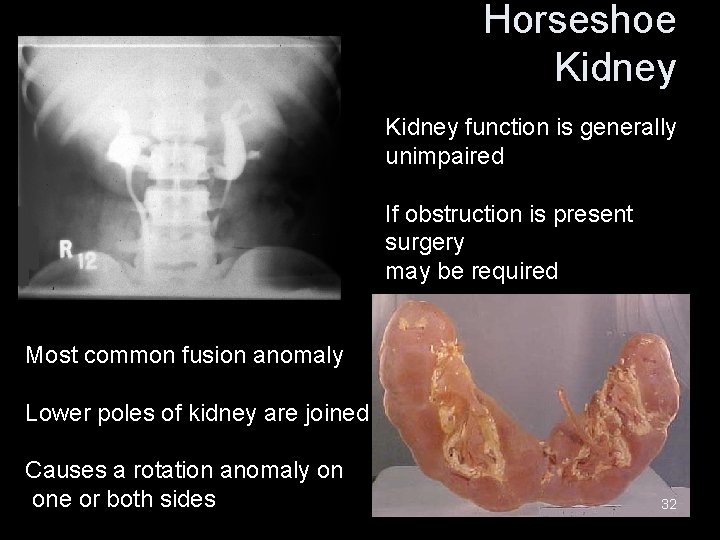 Horseshoe Kidney function is generally unimpaired If obstruction is present surgery may be required