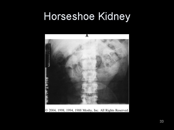Horseshoe Kidney 33 