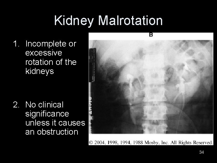 Kidney Malrotation 1. Incomplete or excessive rotation of the kidneys 2. No clinical significance