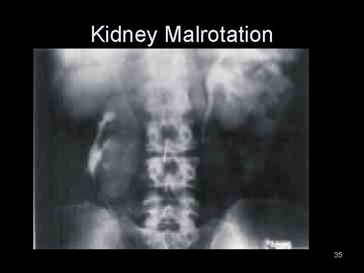 Kidney Malrotation 35 