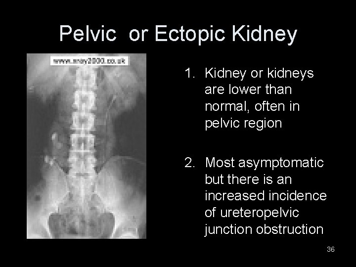 Pelvic or Ectopic Kidney 1. Kidney or kidneys are lower than normal, often in