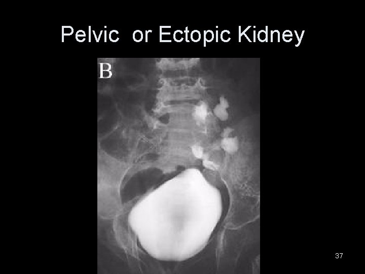 Pelvic or Ectopic Kidney 37 