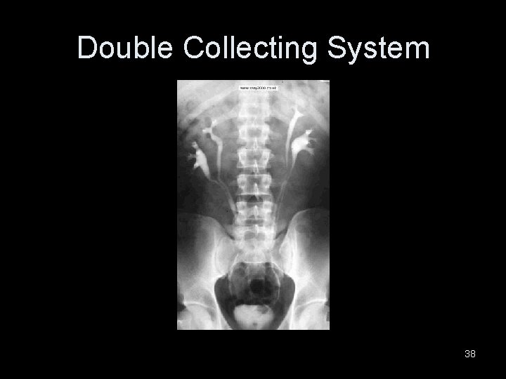 Double Collecting System 38 