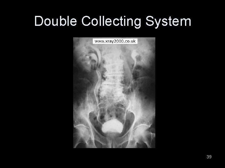 Double Collecting System 39 