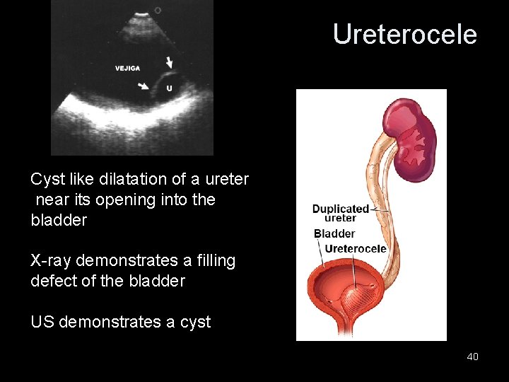 Ureterocele Cyst like dilatation of a ureter near its opening into the bladder X-ray