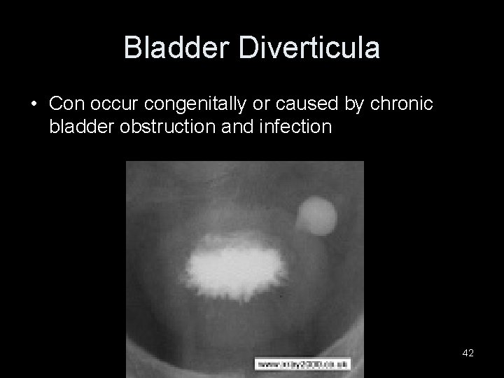 Bladder Diverticula • Con occur congenitally or caused by chronic bladder obstruction and infection