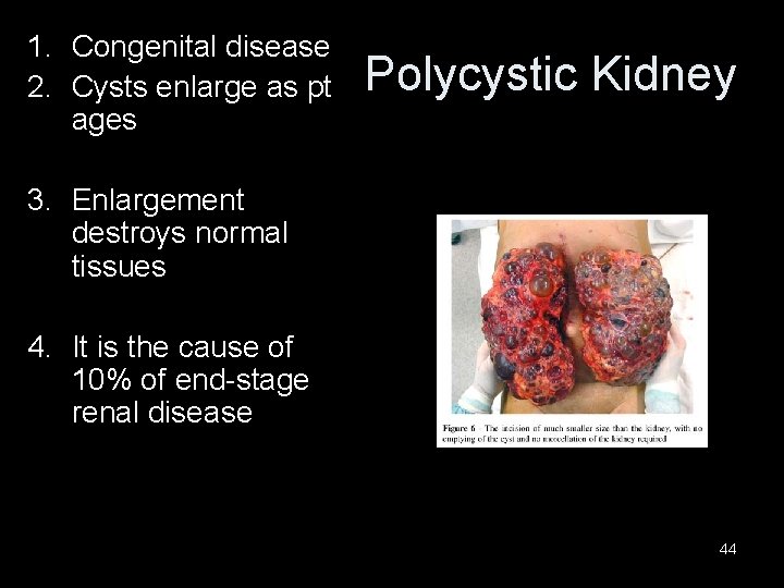 1. Congenital disease 2. Cysts enlarge as pt ages Polycystic Kidney 3. Enlargement destroys