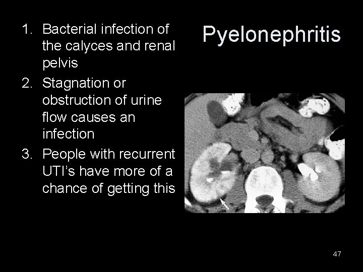 1. Bacterial infection of the calyces and renal pelvis 2. Stagnation or obstruction of