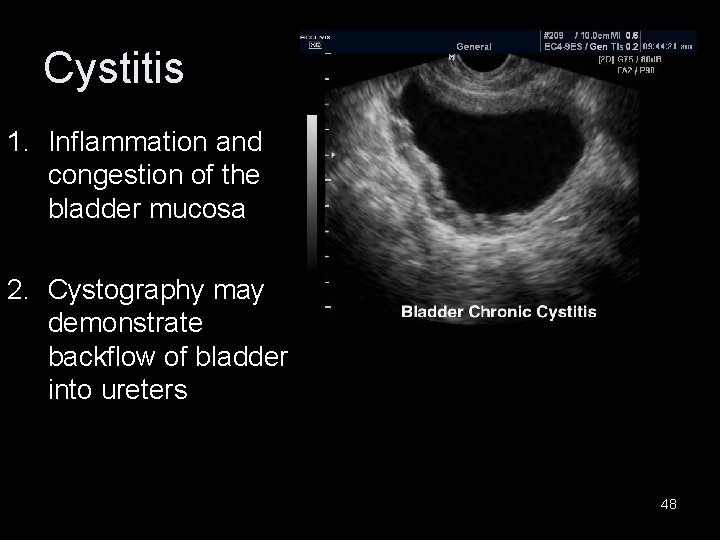 Cystitis 1. Inflammation and congestion of the bladder mucosa 2. Cystography may demonstrate backflow