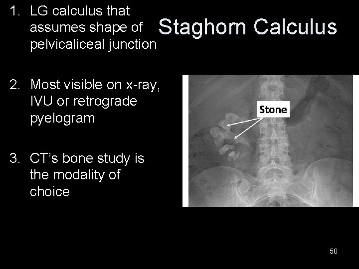 1. LG calculus that assumes shape of Staghorn pelvicaliceal junction Calculus 2. Most visible