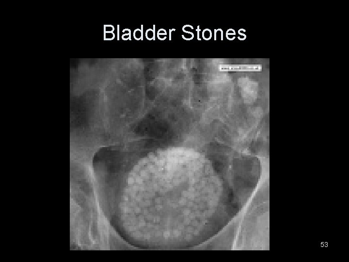 Bladder Stones 53 