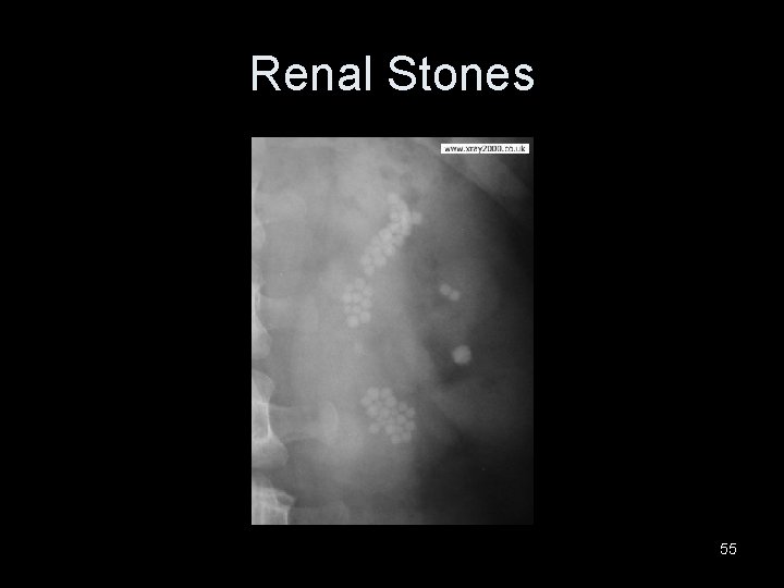 Renal Stones 55 