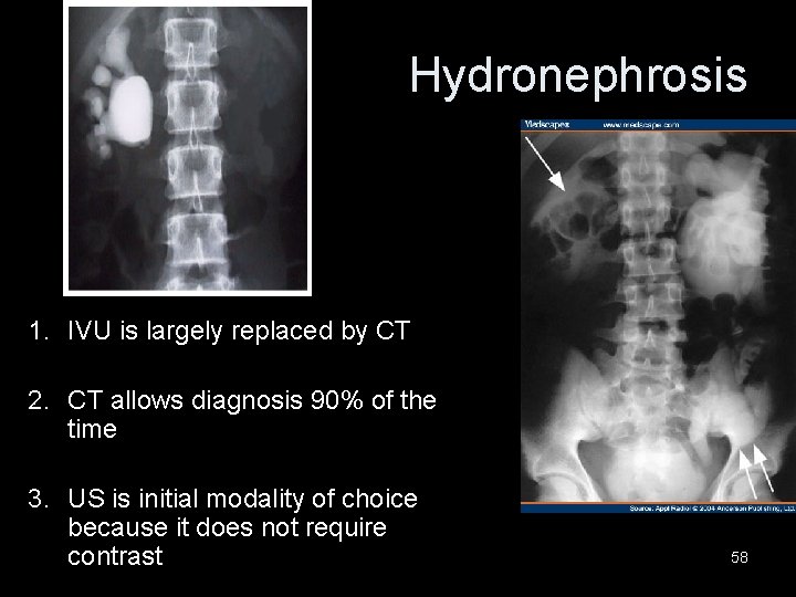 Hydronephrosis 1. IVU is largely replaced by CT 2. CT allows diagnosis 90% of