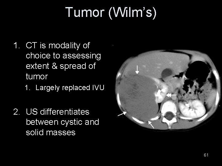 Tumor (Wilm’s) 1. CT is modality of choice to assessing extent & spread of