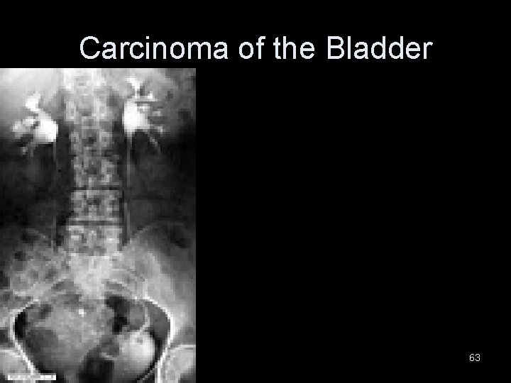 Carcinoma of the Bladder 63 