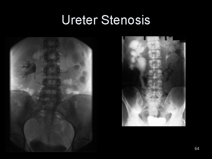 Ureter Stenosis 64 