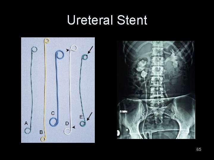 Ureteral Stent 65 